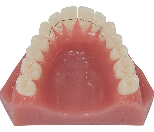 Bonded Retainer