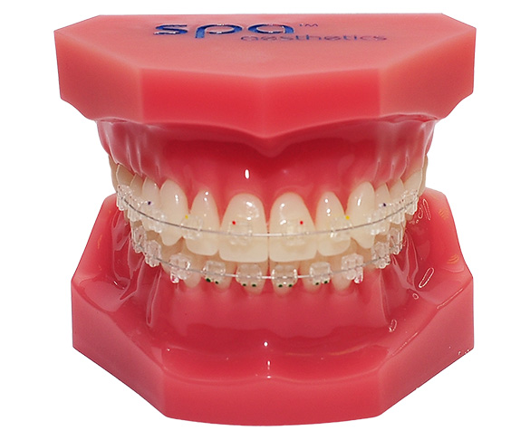 Indirect Bonding Trays